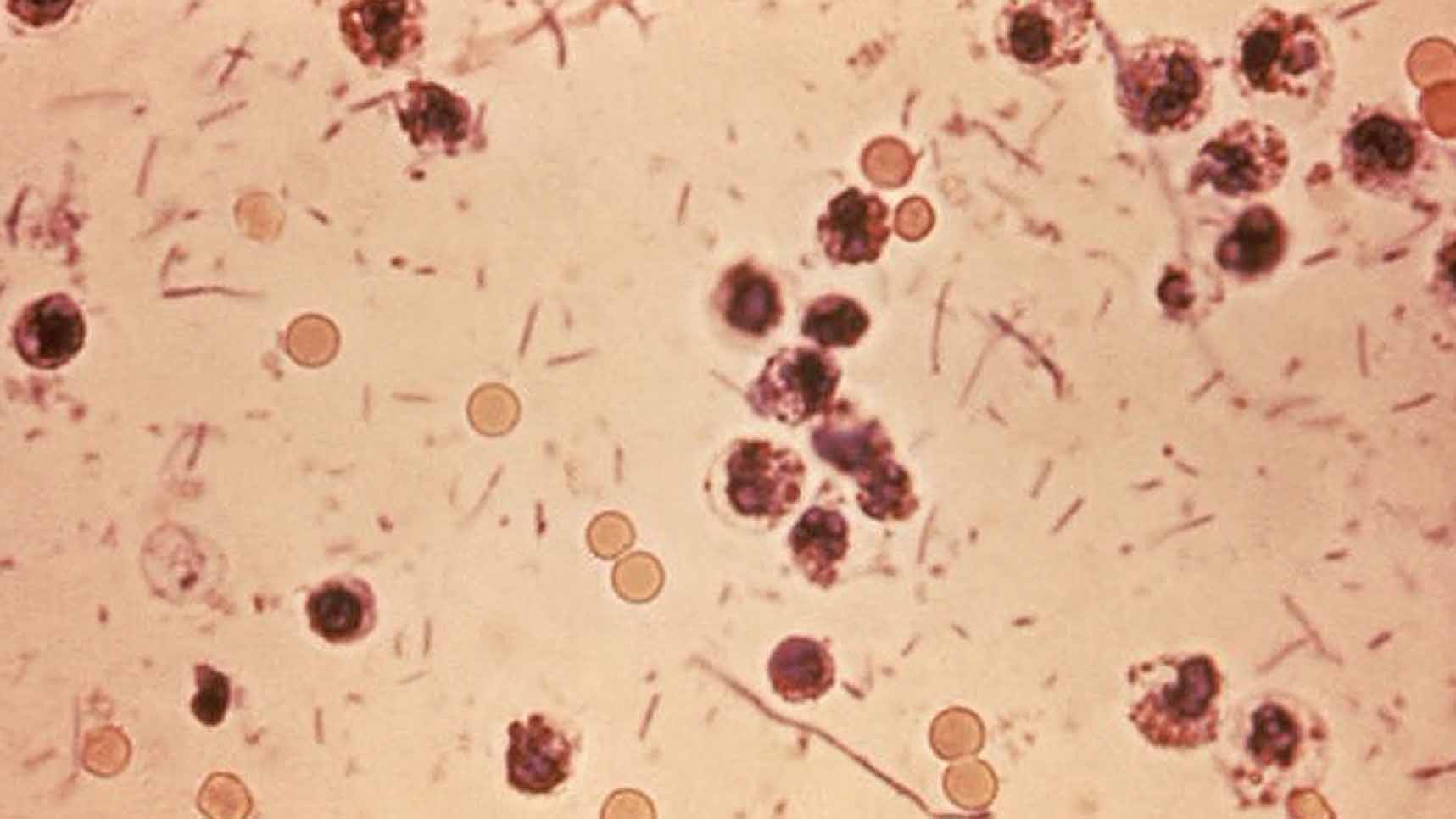 Image of disease specimen microscopically enlarged